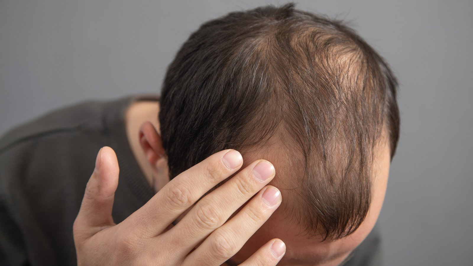 Hairfall Treatment