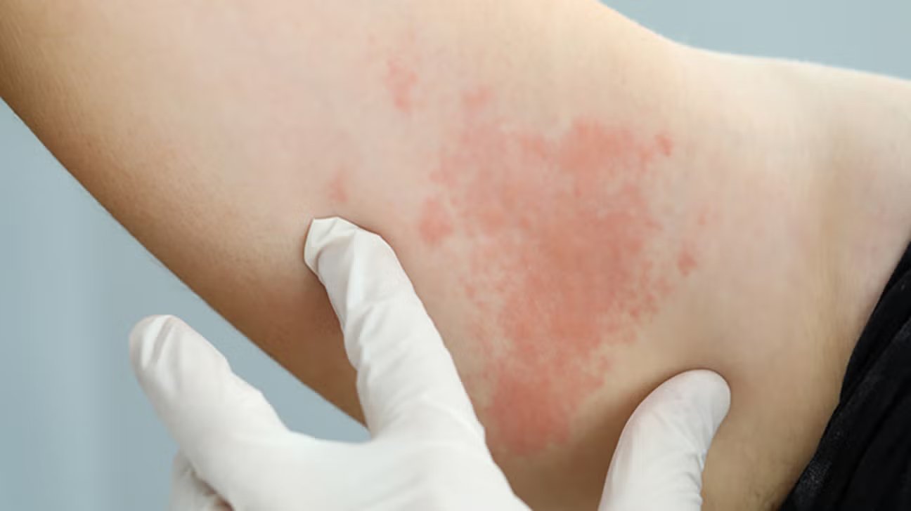 Skin Diseases